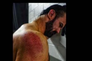 Photo: Drew McIntyre Shows Off Bruise Following An Attack From Roman Reigns On WWE SmackDown 8/26