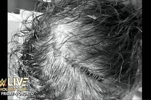 WWE Provides Injury Update On Sami Zayn; 15 Staples Required In Totoal After The Toronto Show