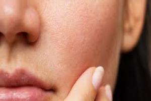 TYPES OF SKIN