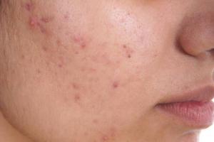 ACNE-INTRODUCTION, CAUSES, SYMPTOMS AND AYURVEDIC TREATMENT AND HOME REMEDIES