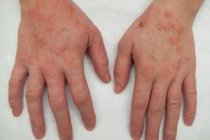 ECZEMA-INTRODUCTION,SIGN&SYMPTOMS,TREATMENT AND HOME REMEDIES