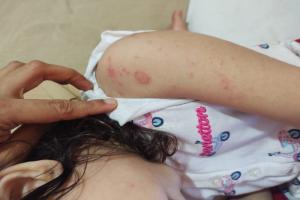 IMPETIGO
ACCORDING TO ALLOPATHY AND AYURVEDA(INTRODUCTION,CAUSES,SIGN & SYMPTOMS AND TREATMENT)