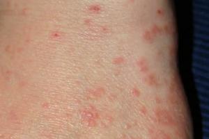 Scabies
Introduction, causes, symptoms and treatment