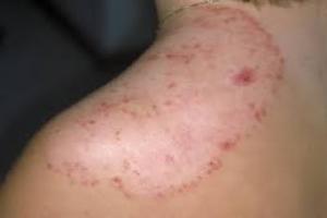 DADRU KUSTHA(TINEA INFECTION)-INTRODUCTION,CAUSES,SYMPTOMS AND MANAGMENT