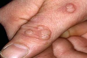 WARTS-CAUSES, SYMPTOMS AND MANAGMENT ACCORDING TO AYURVEDA AND  MODERN SCIENCE