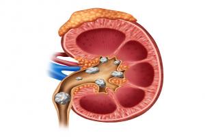 Treatment and Home remedies for kidney stone